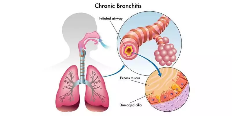 Penyebab Penyakit Bronkitis Dan Cara Mengobati