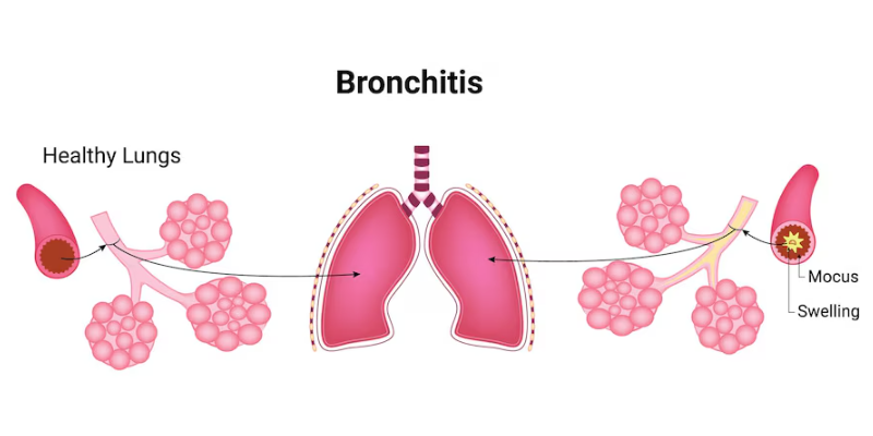 Pencegahan Untuk Penyakit Bronkitis